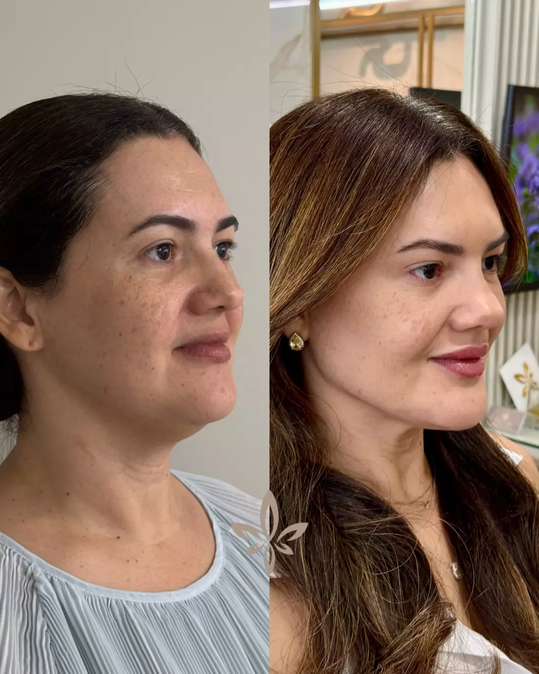 Caso Ellida — Rejuvenescimento natural com o Método Éclair