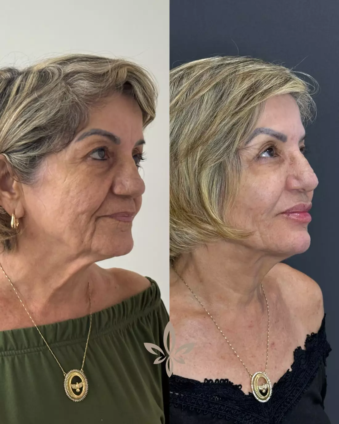 Caso Glória — Reestruturação completa com o Método Éclair