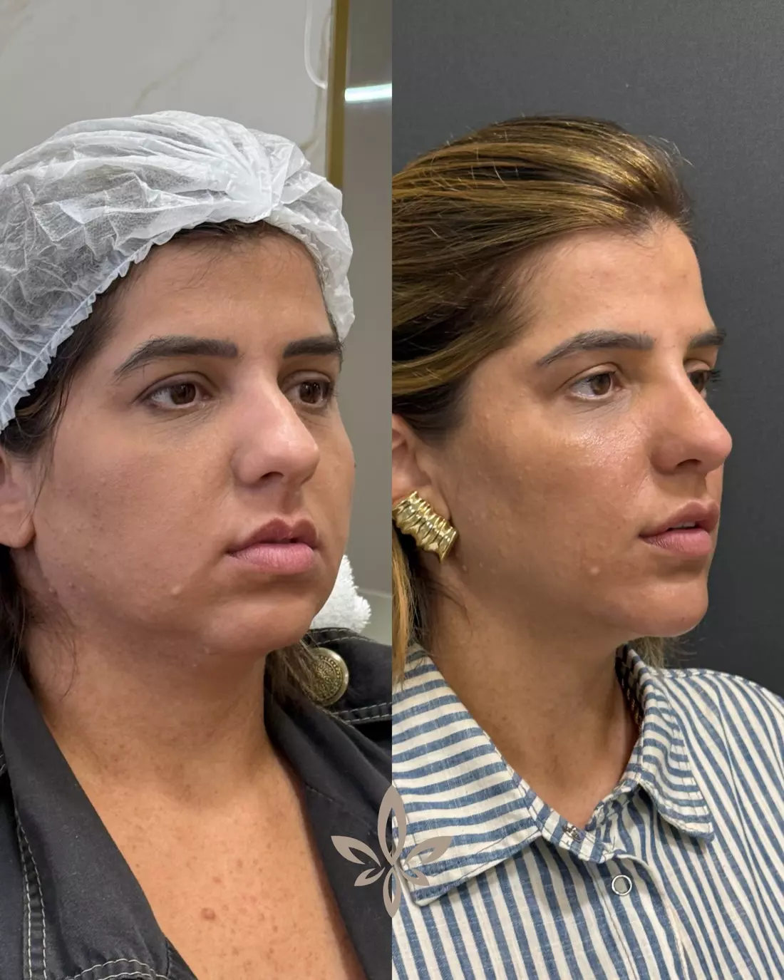 Caso Jennefer — Harmonia do conjunto com o Método Éclair