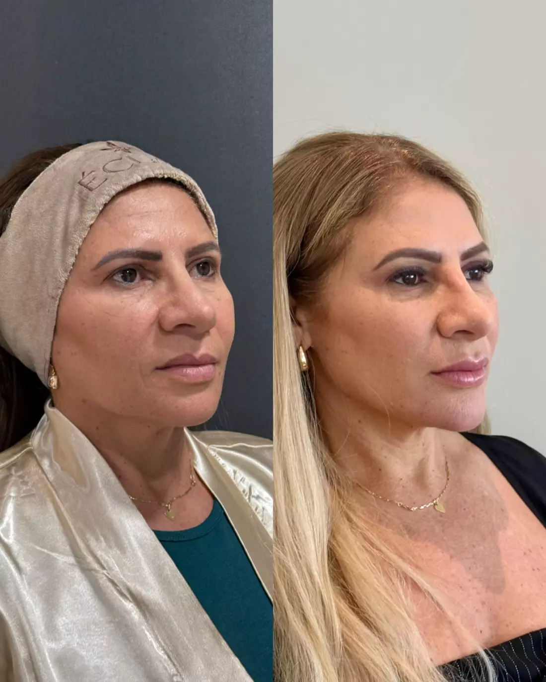 Caso Marta — Contorno e sustentação com o Método Éclair